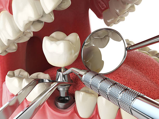 Best Emergency Dentist for Lost Fillings or Crowns in Keystone Heights, FL